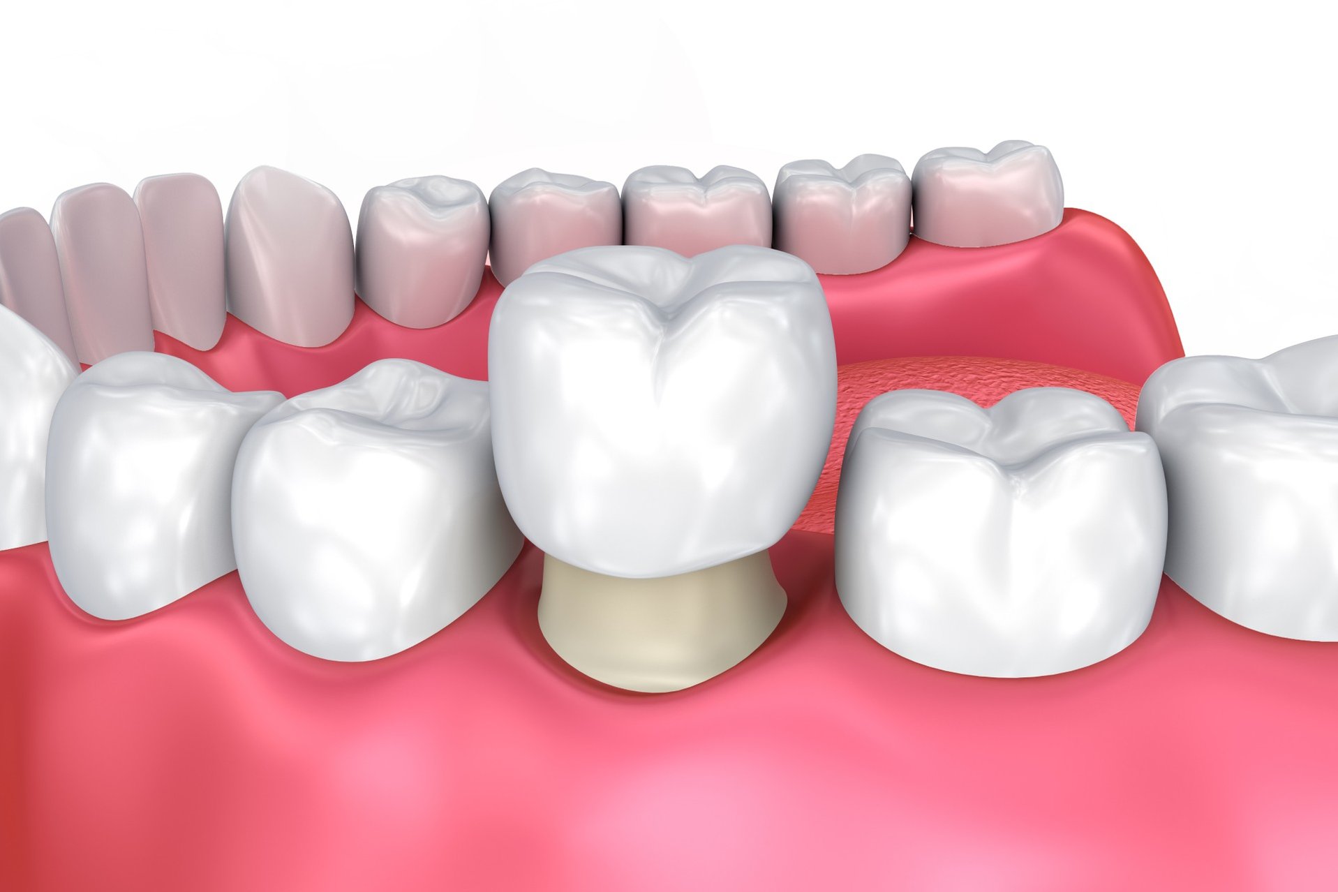 Dental Crown Illustration