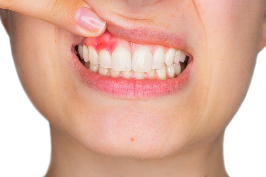 Why Are My Gums Bleeding? 9 Common Causes and Solutions