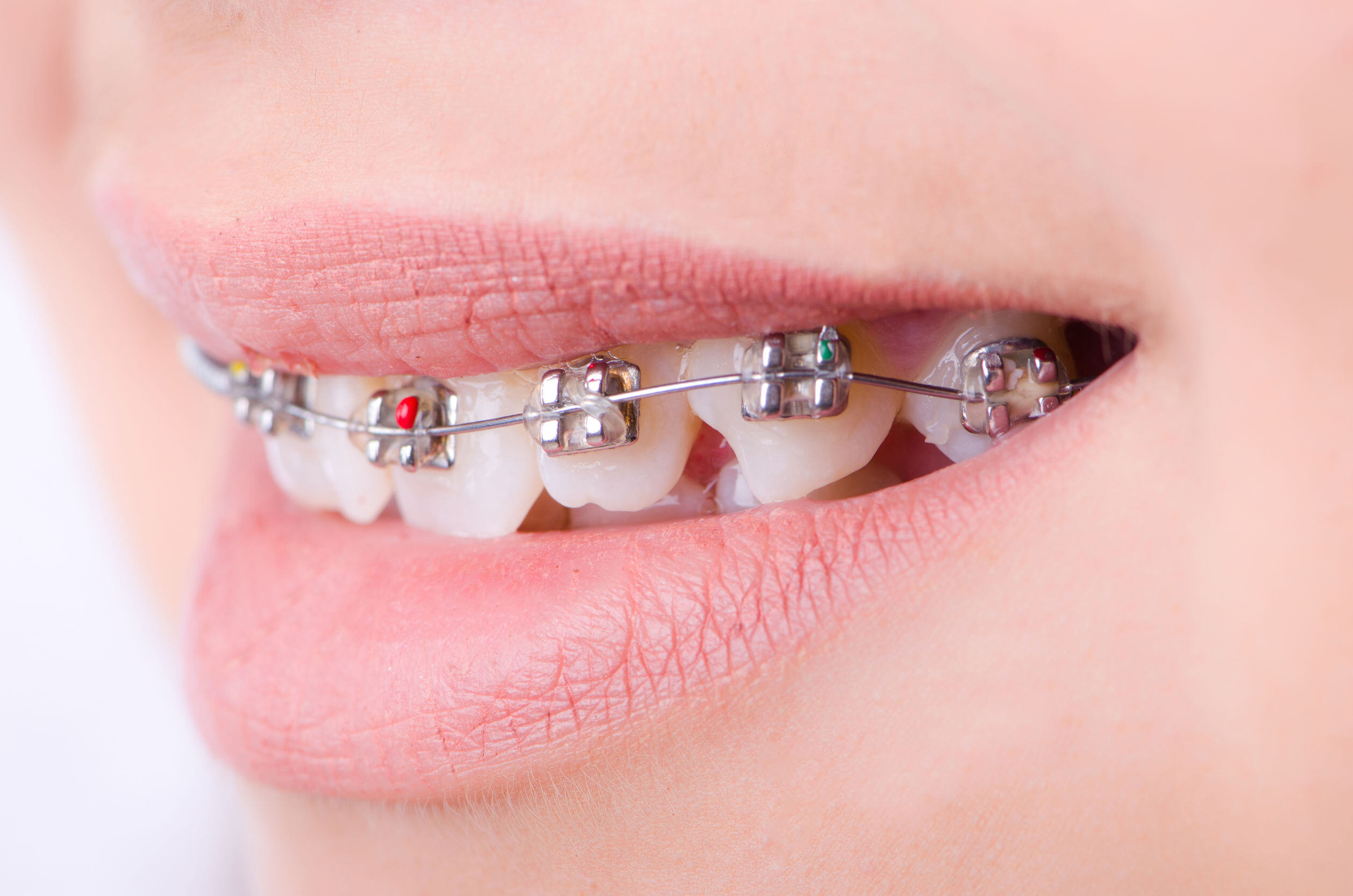 10 Most Frequently Asked Questions About Orthodontic Treatment