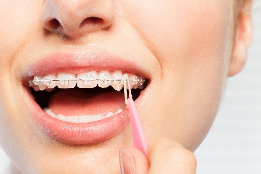 Orthodontic Elastics (Rubber Bands) & How They Work