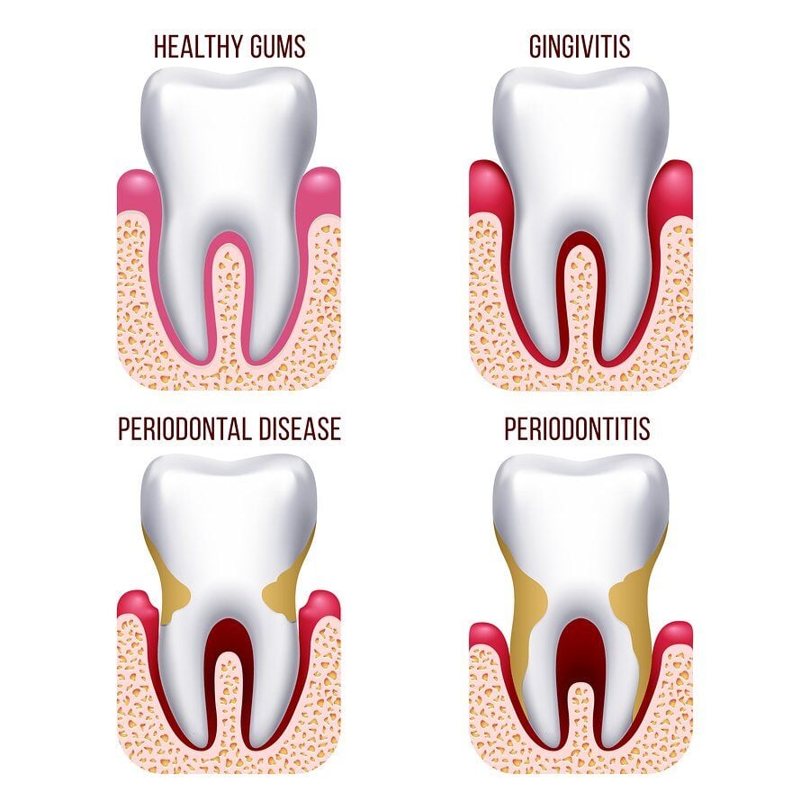 Gum Disease Care Guide: Protecting Your Gums and Oral Health