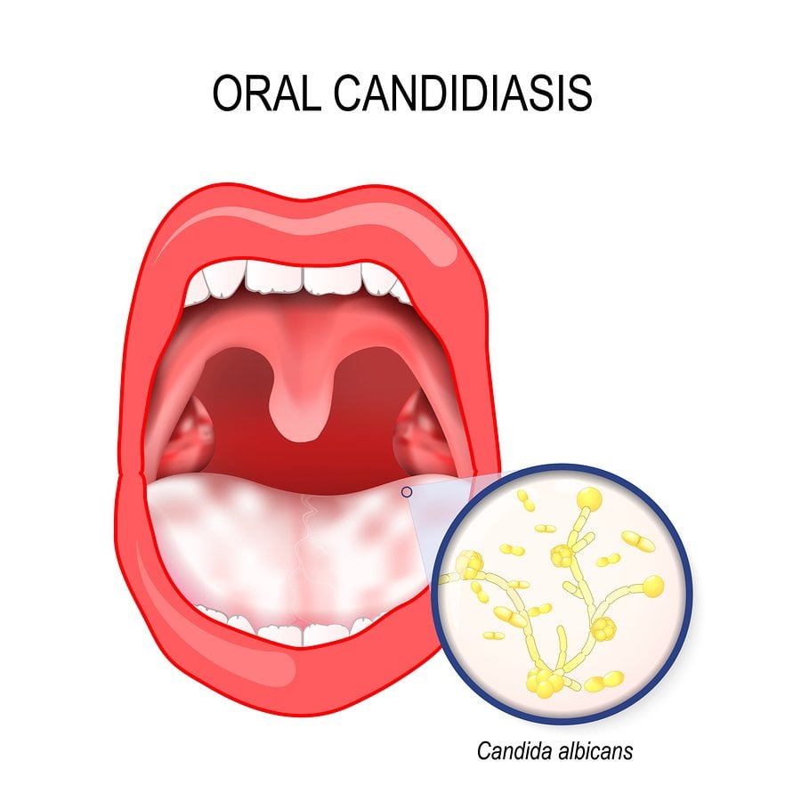 Oral Thrush Symptoms & Effective Home Remedies