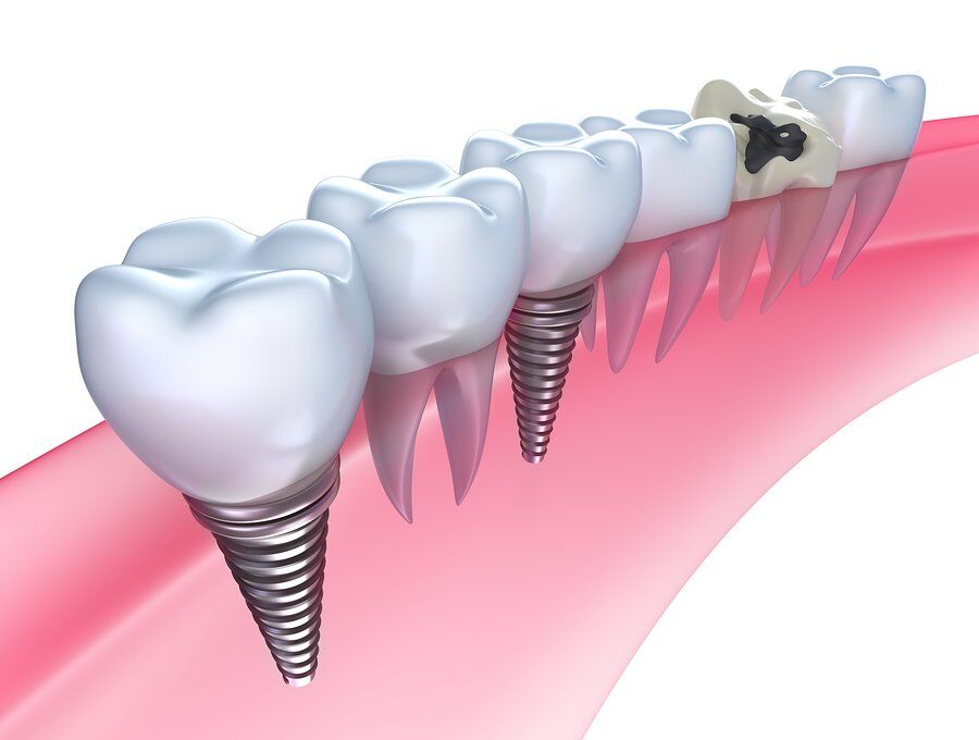 Dental Implants Explained: Benefits, Costs & Care Guide