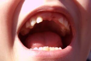 Baby Bottle Tooth Decay: What It Is and 12 Tips for Reducing Your Child’s Risk