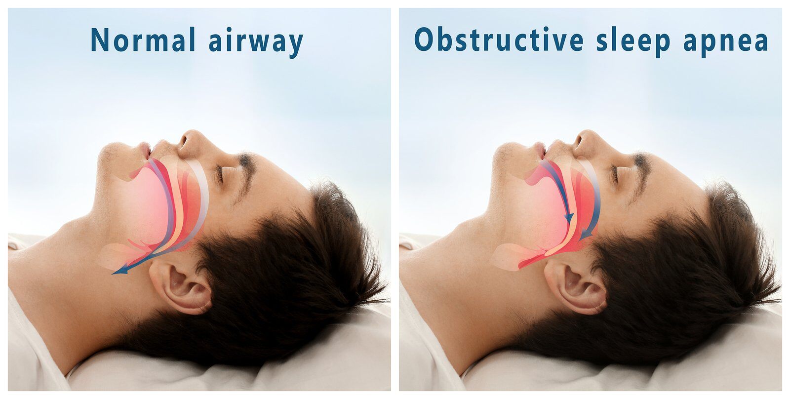 Sleep Apnea and Oral Health: How They’re Connected